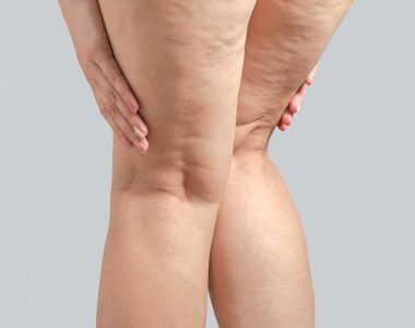 Lipedema